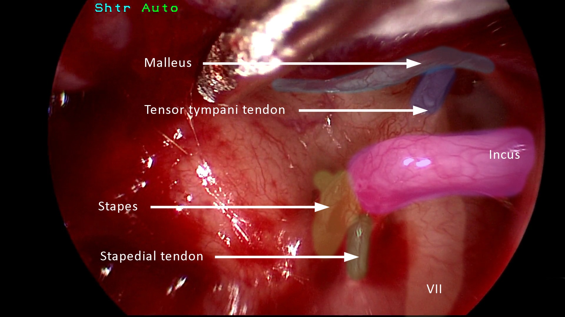 Une image chirurgicale otoendoscopique d'oreille moyenne avec annotation