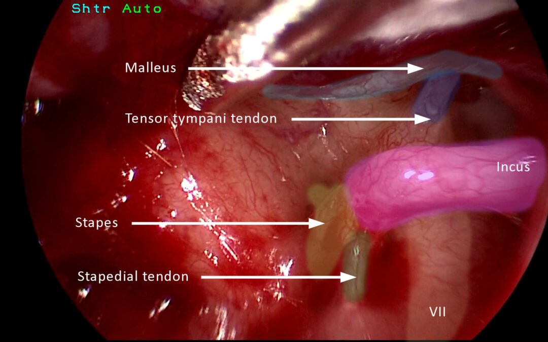 Transitions, titles and overlays : what is the ideal tempo for educational surgical video?